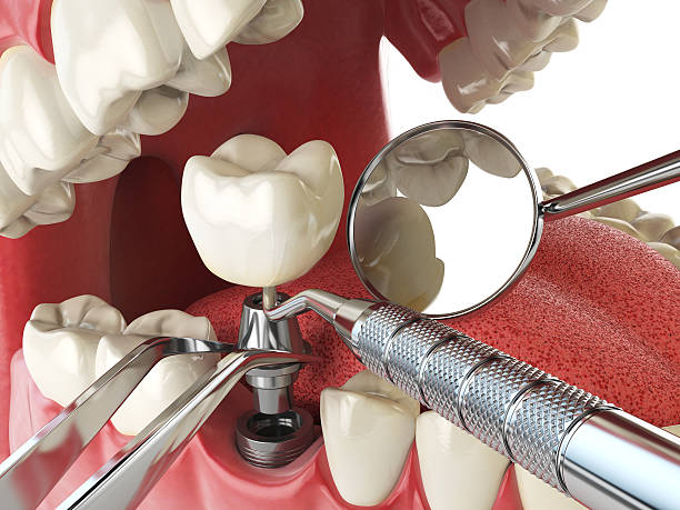 Best Emergency Dentist for Lost Fillings or Crowns in Wharton, NJ